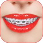 Braces 2018 for PC