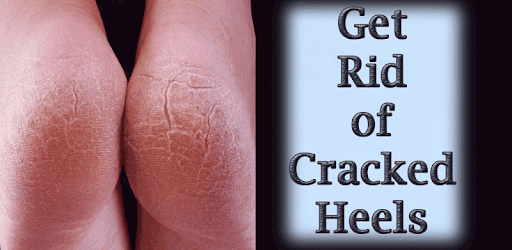 Get Rid of Cracked Heels PC screenshot