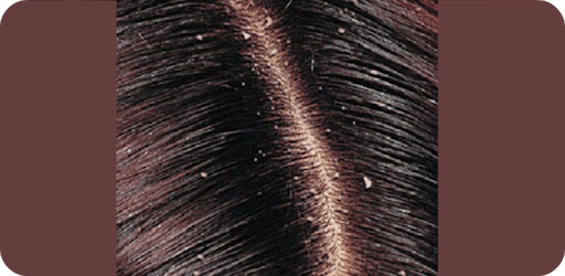 How to Rid Of Dandruff PC screenshot