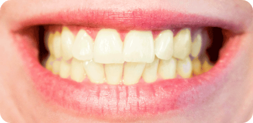 How to Whiten Teeth Instantly PC screenshot