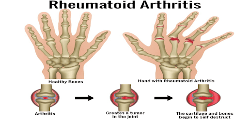 Arthritis PC screenshot