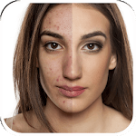 Pimple Eraser Photo Editor for PC