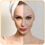 Pimple Remover Acne Remover icon
