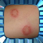 Ringworm Home Treatment for PC