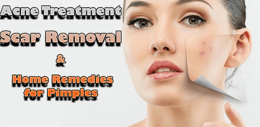 Remedies for Pimples, Acne Treatment, Scar Removal PC screenshot
